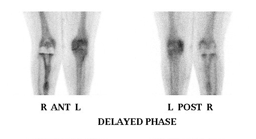 Bone Scan Loose Revision TKR